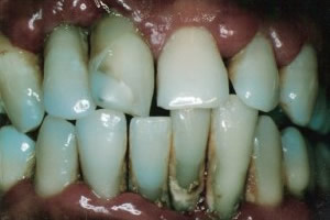 Advanced periodontal disease